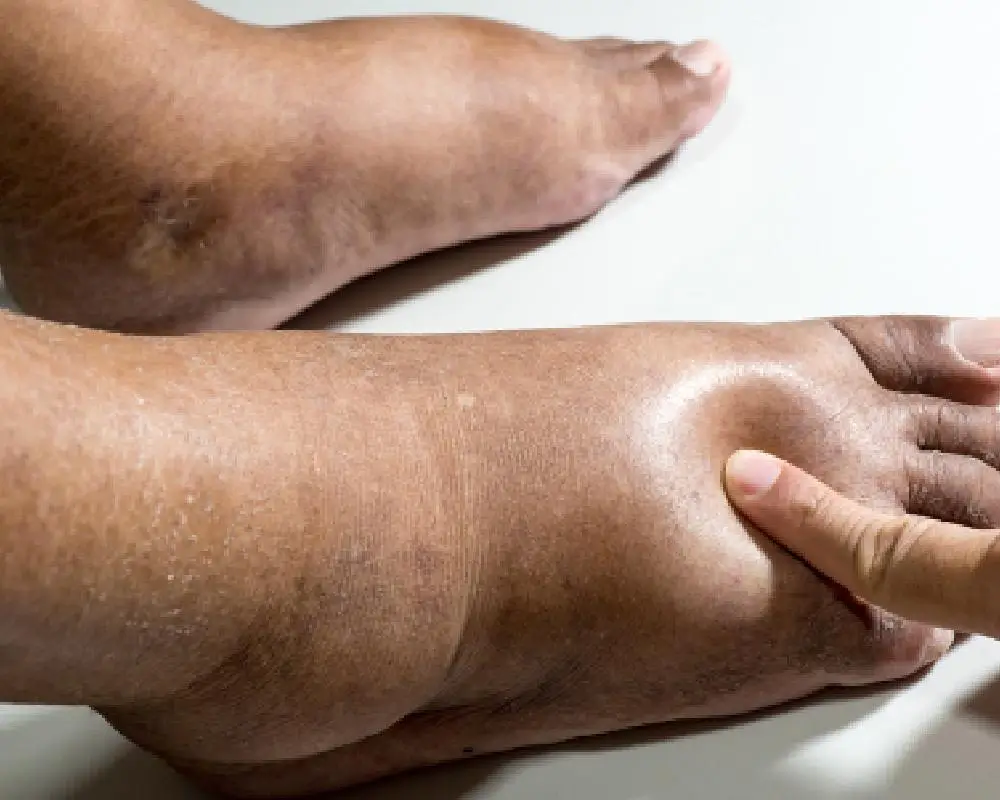 lymphedema